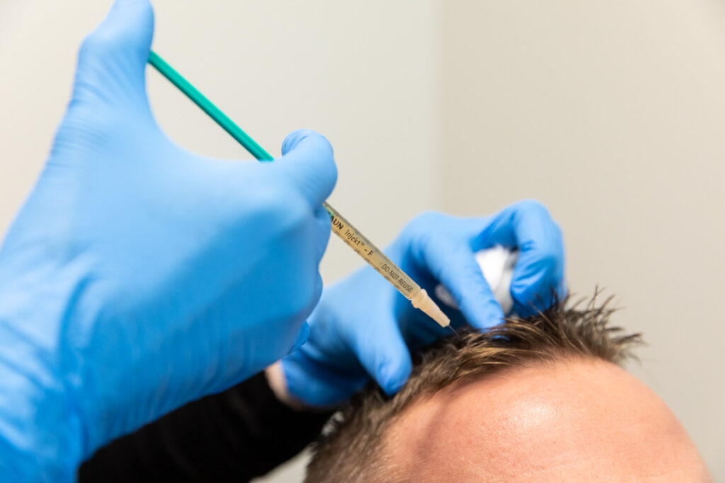 Close up of a treatment for hair restoration in Sewickley at Your Skin Prescription