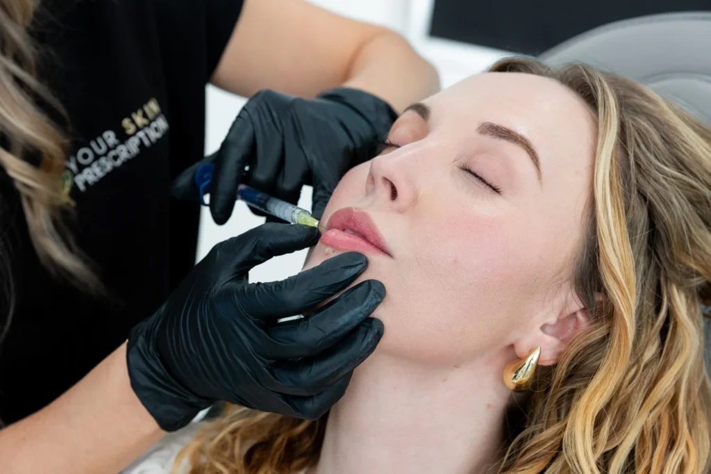 Close up of a woman getting a lip injection of dermal filler near Pittsburgh