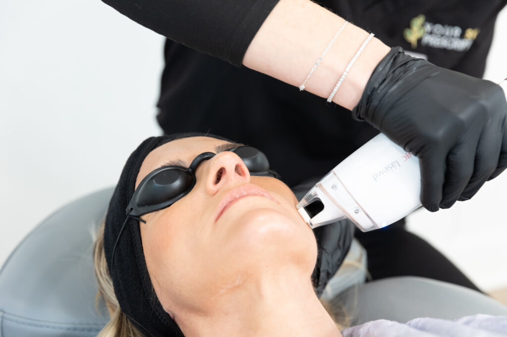Close up of a woman recieving a laser facial