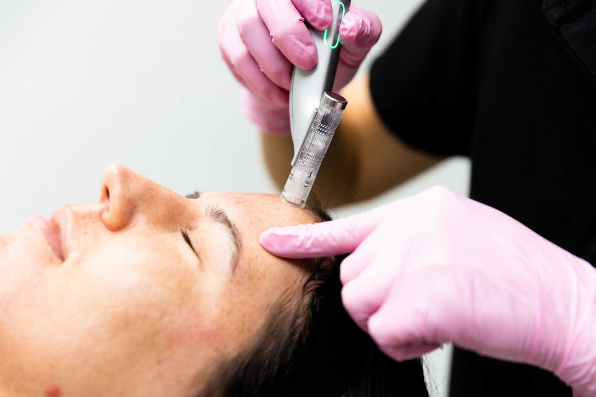 A woman undergoes a skin clearing treatment called microneedling near Pittsburgh