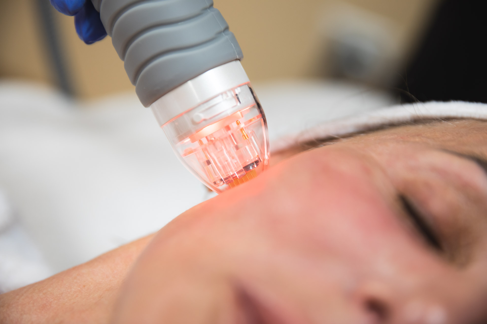 Close up of RF microneedling treatment on a woman's face