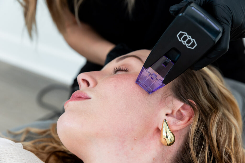 Close up of a woman experiencing RF microneedling near Ambridge, PA