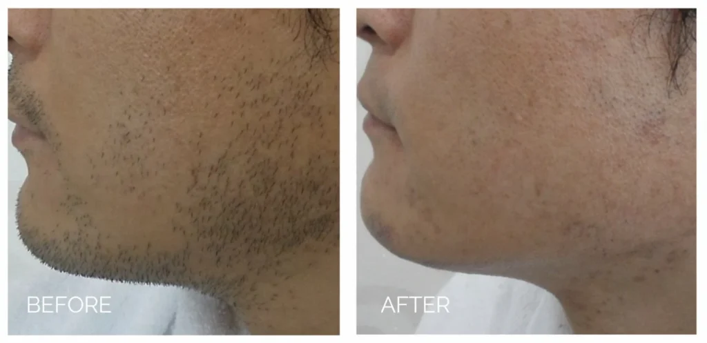 laser hair removal in sewickley