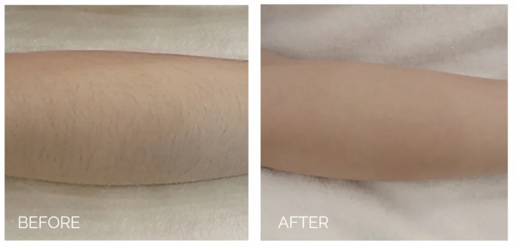 laser hair removal in Sewickley
