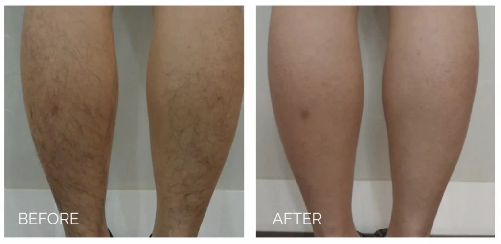 laser hair removal in Sewickley