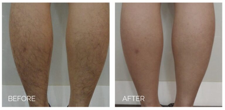 laser hair removal in Sewickley