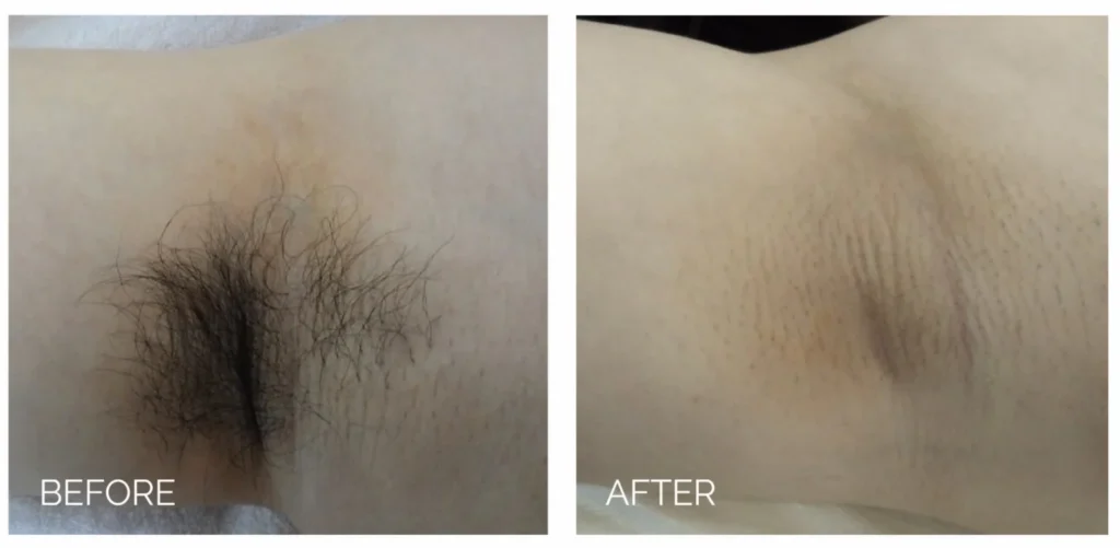 laser hair removal in Sewickley